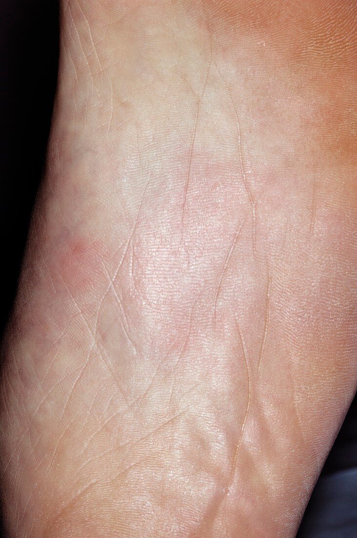 Thermal urticaria on the foot