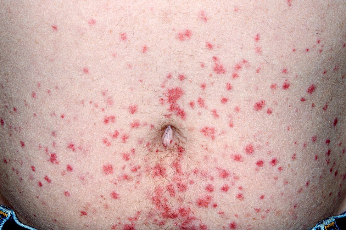 Allergic purpura on the abdomen