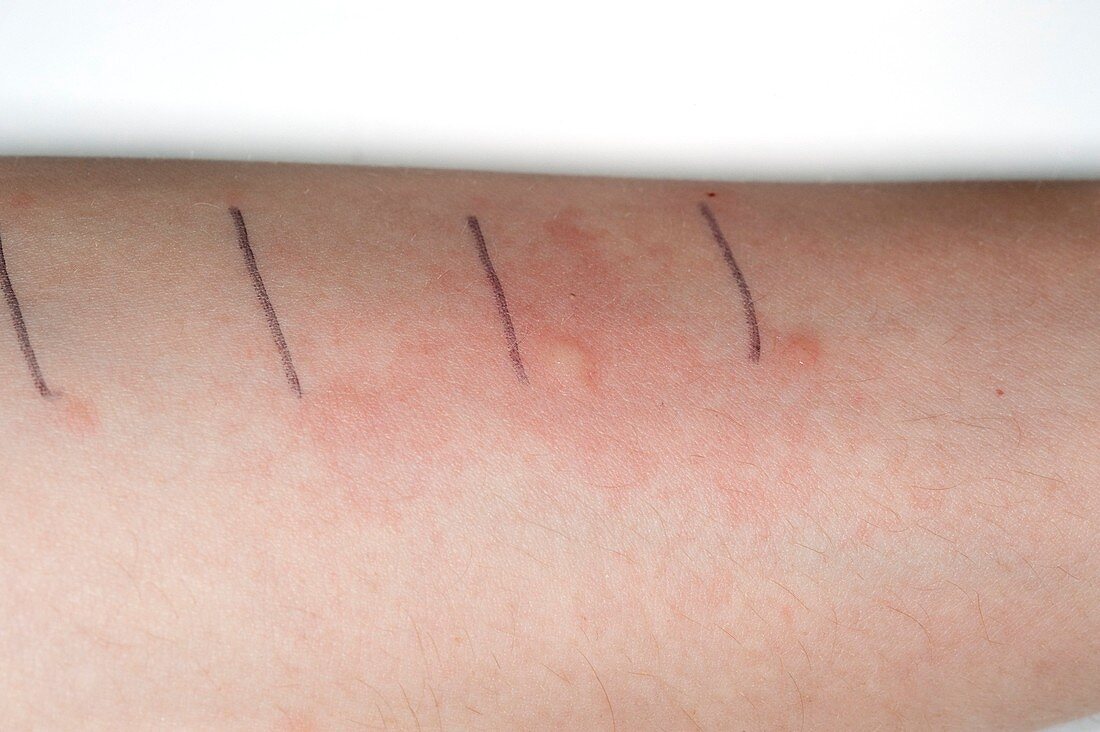 Skin prick testing for allergies