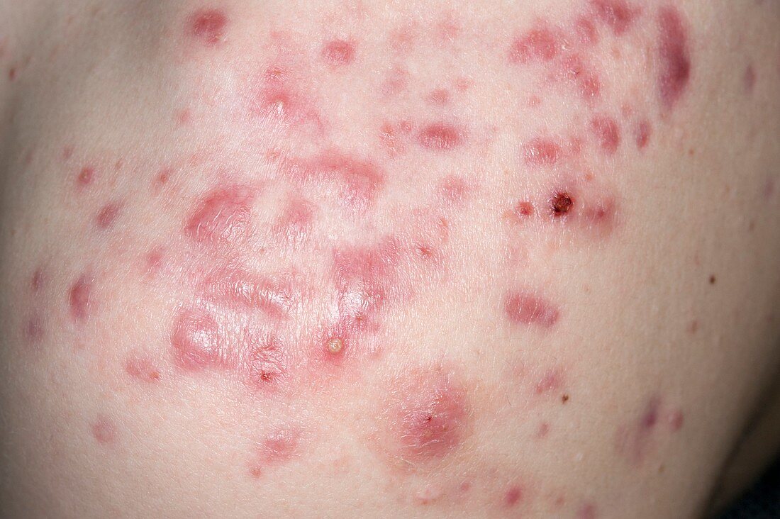 Acne vulgaris on the skin