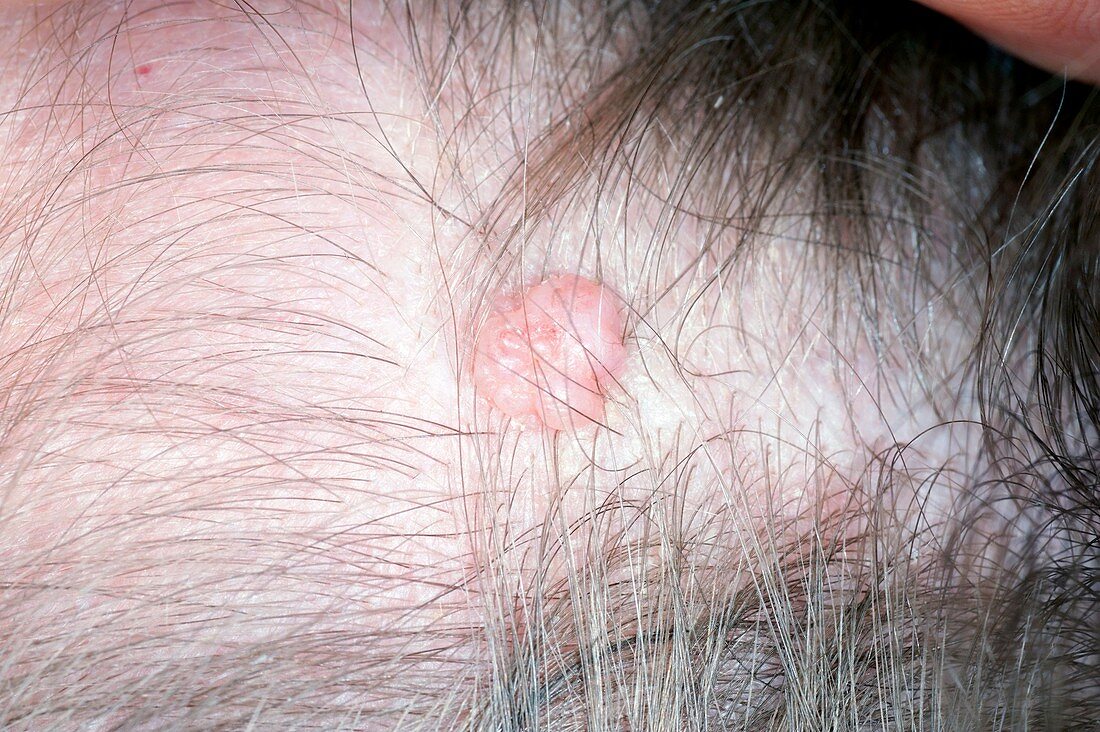 Intradermal mole (naevus) on the scalp
