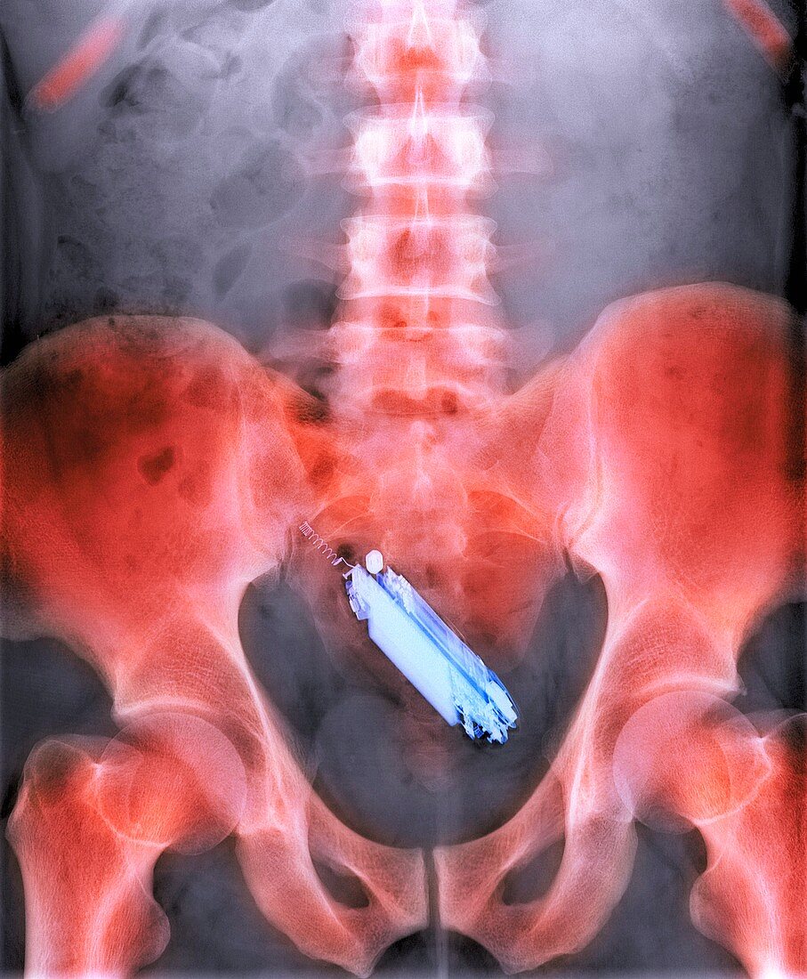 Mobile phone in a person's rectum,X-ray