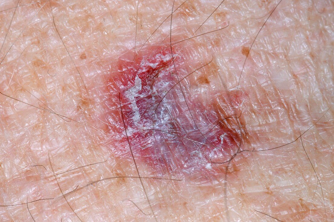Liver spot (lentigo) on the skin