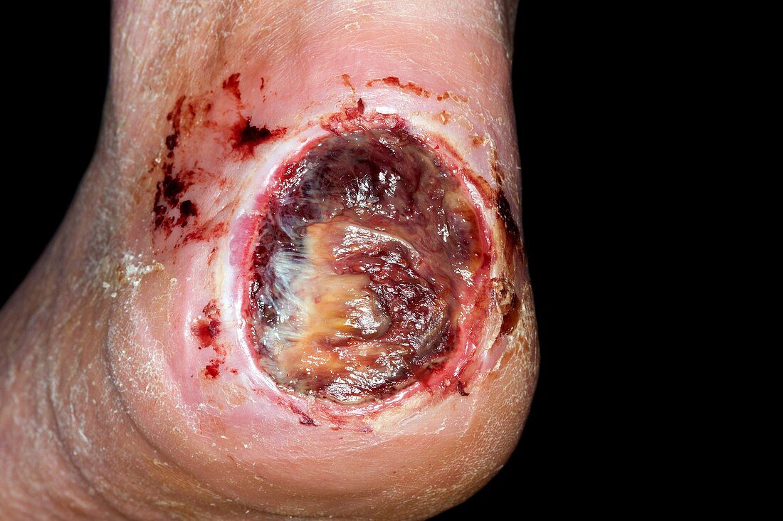 Diabetic foot with large heel ulcer