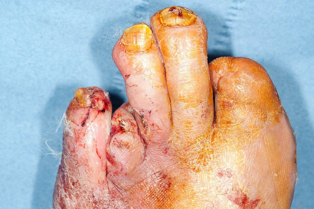 Diabetic foot with amputated toes