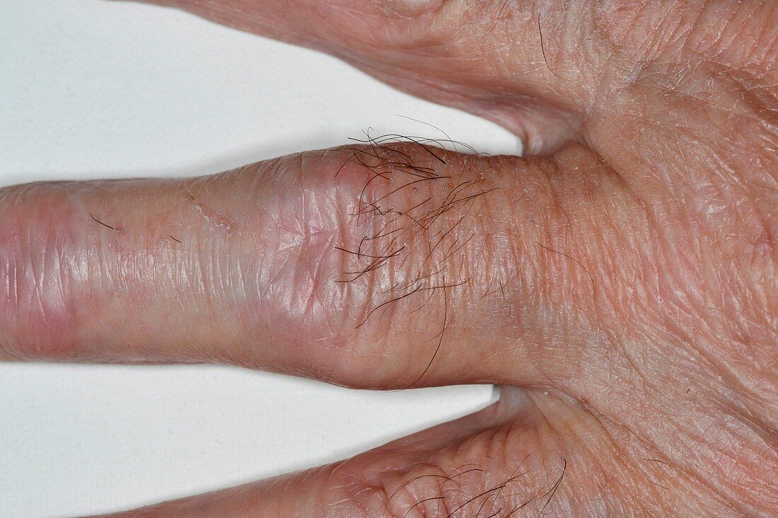 Rheumatoid arthritis of the finger