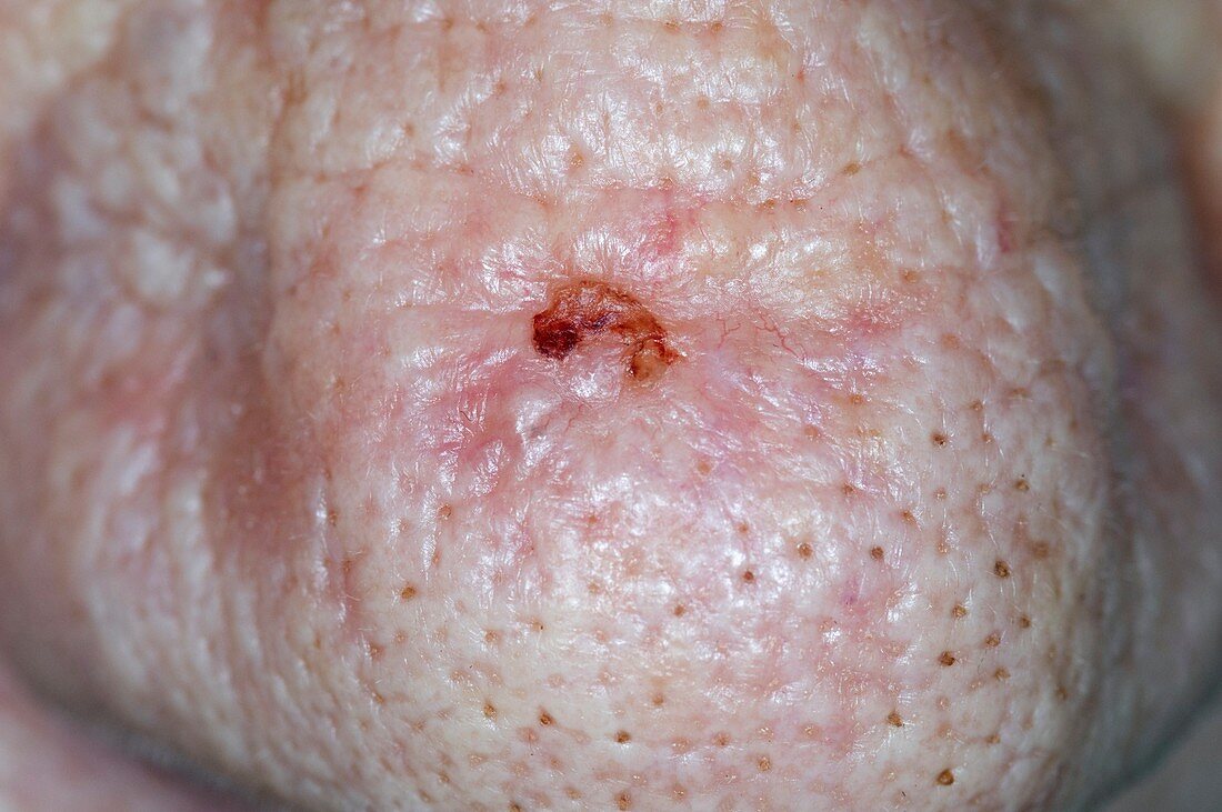 Basal cell skin cancer on the nose