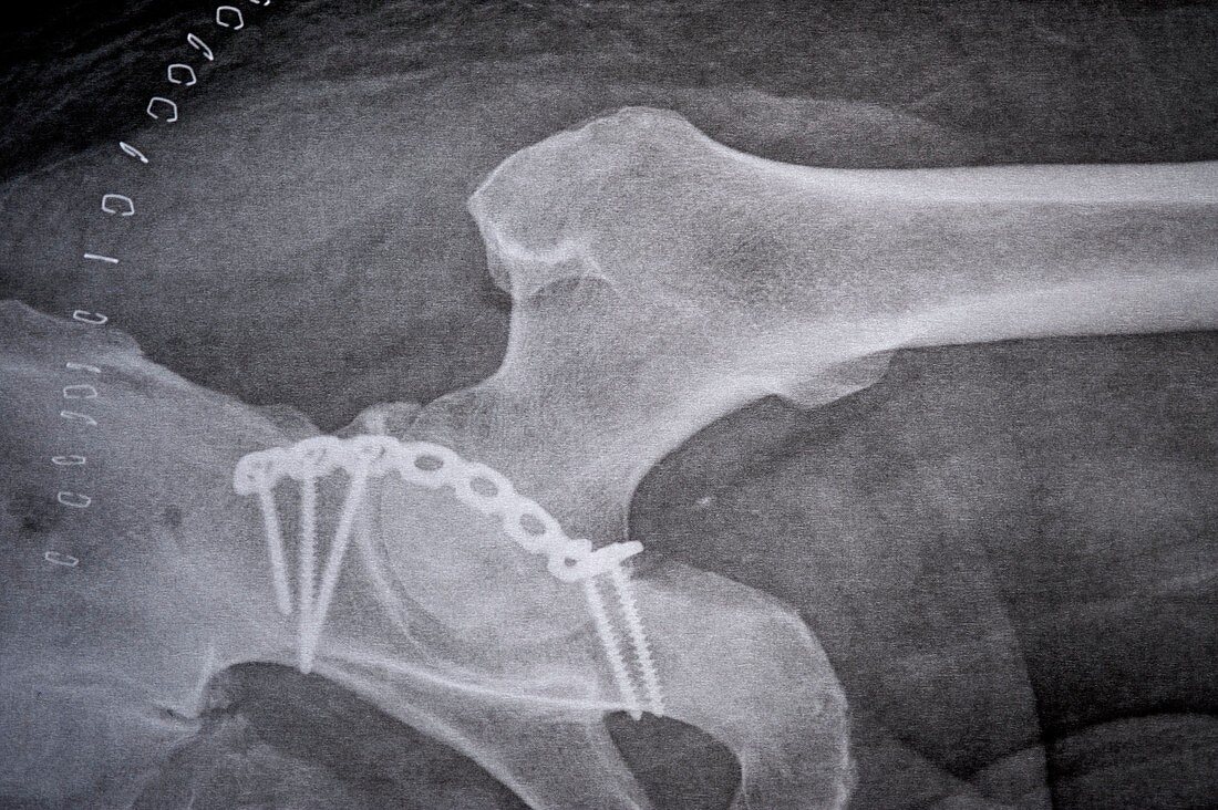 Pinned pelvic fracture,X-ray