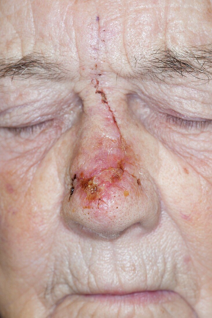 Skin cancer surgical scar
