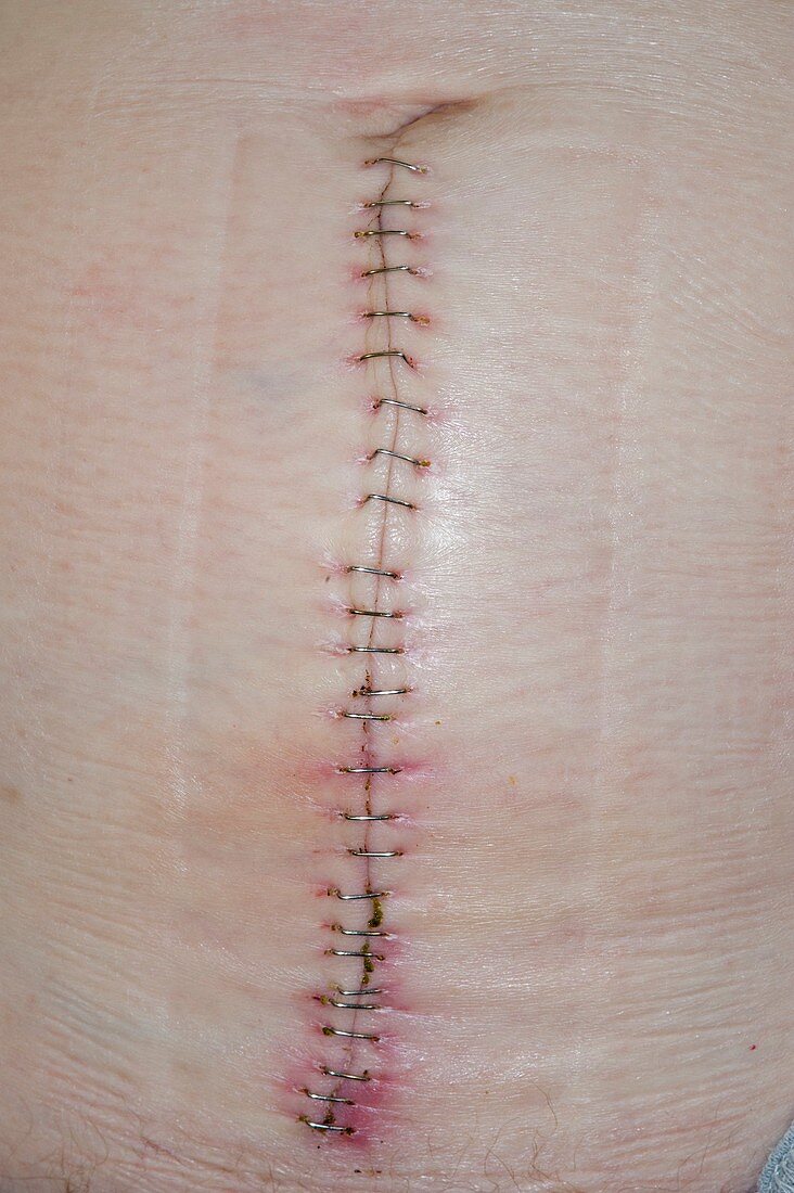 Metal staples on an abdominal wound