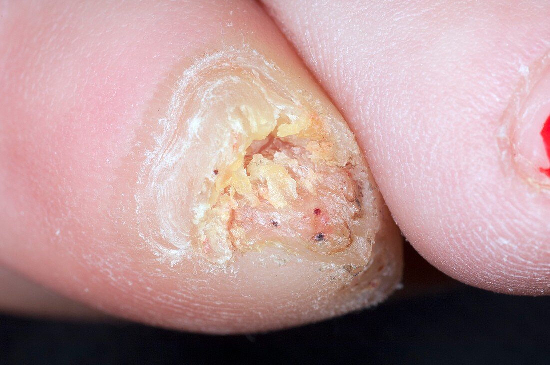 Wart (verruca) under the toenail