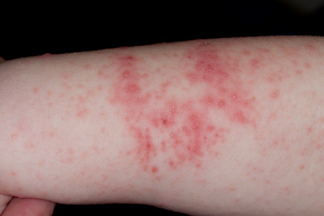 Lesions from hand,foot & mouth disease