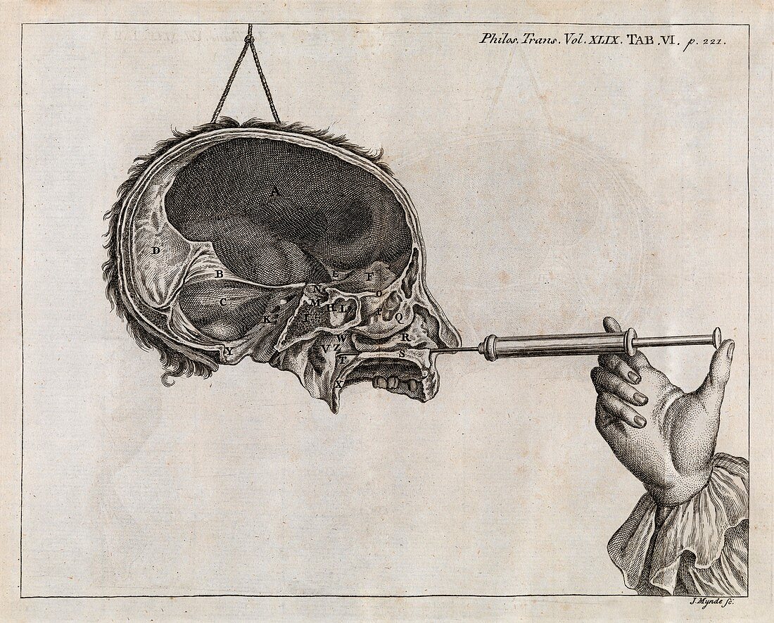 Eustachian tube syringing,18th century