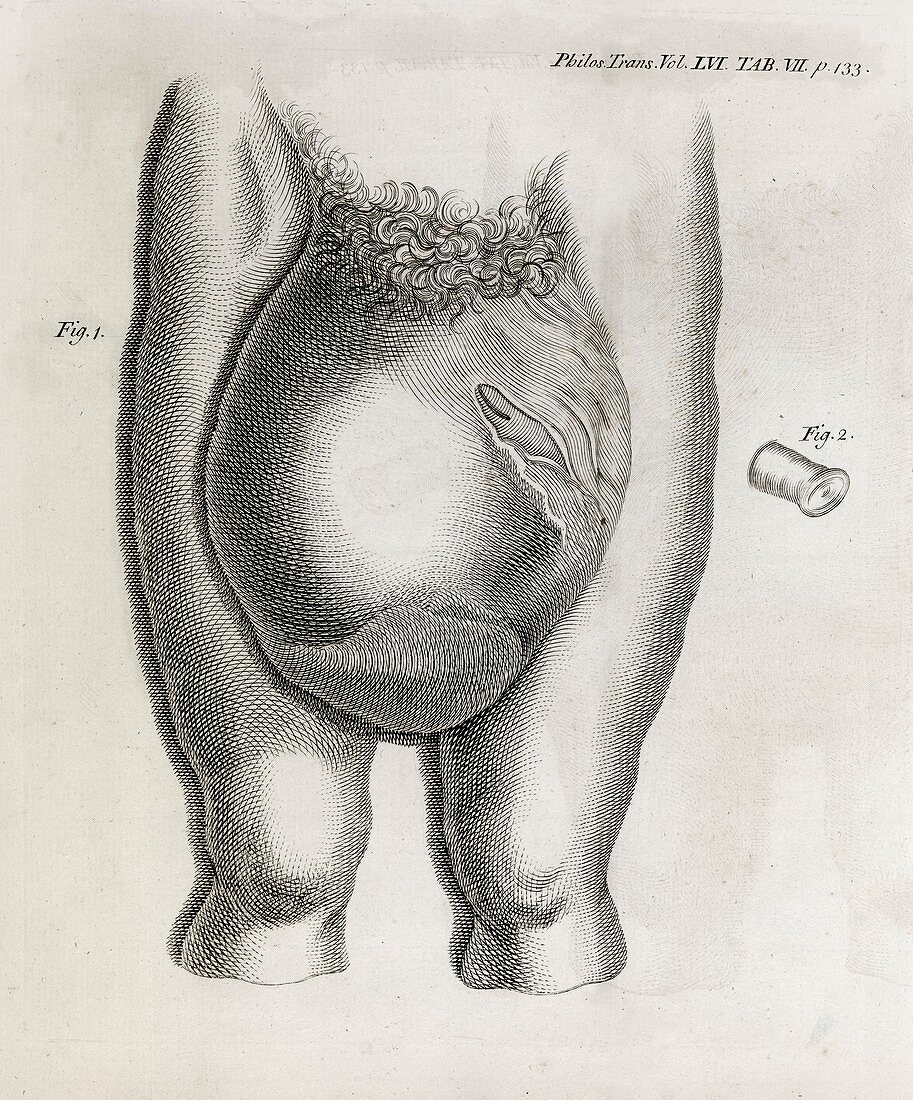 Large hernia,18th century