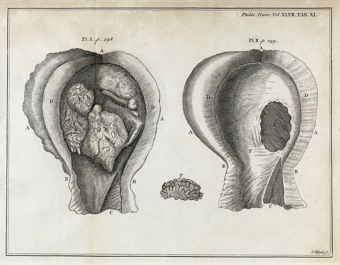 Fungal bladder infection,18th century