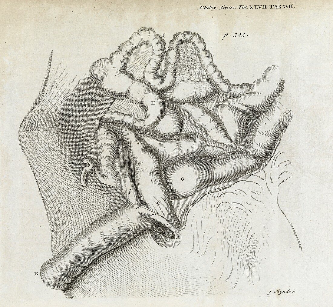 Fistula and hernia,18th century