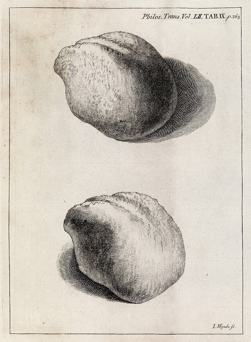 Kidney stone,18th century