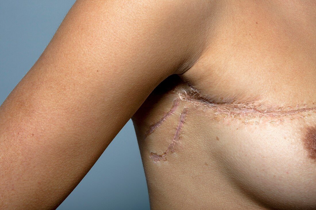 Breast cancer surgery scar