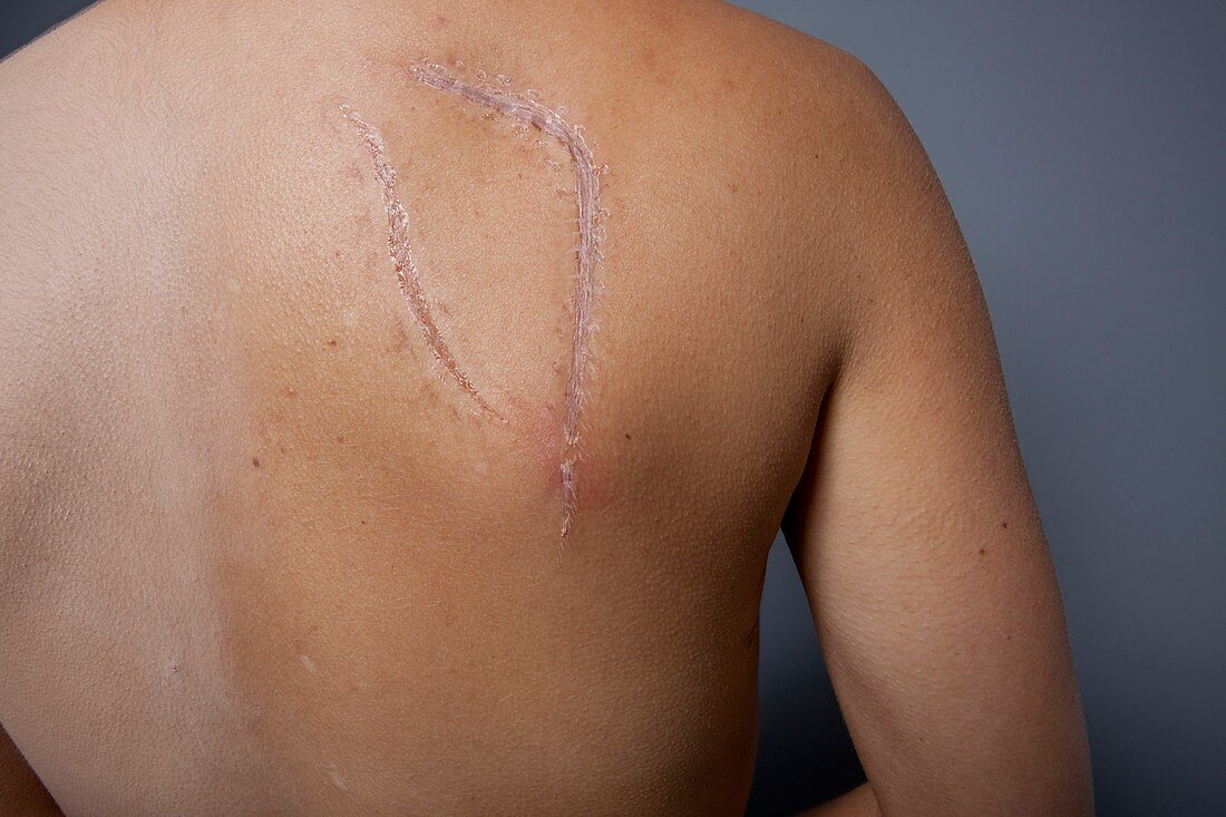 Breast cancer surgery scar