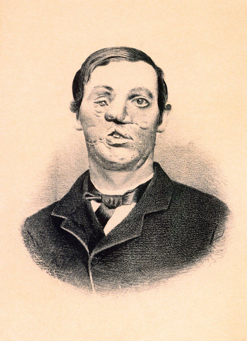 Early reconstructive surgery,1860s