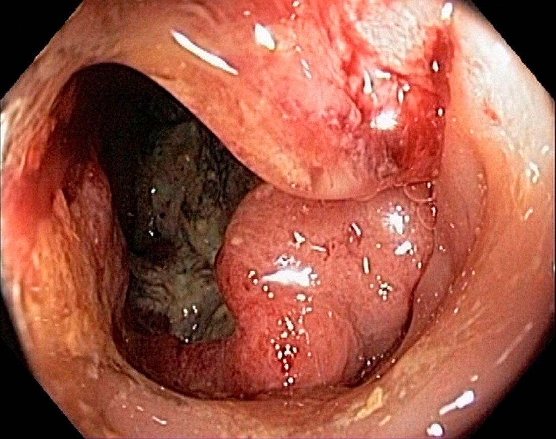 Rectal cancer,colonoscopic view