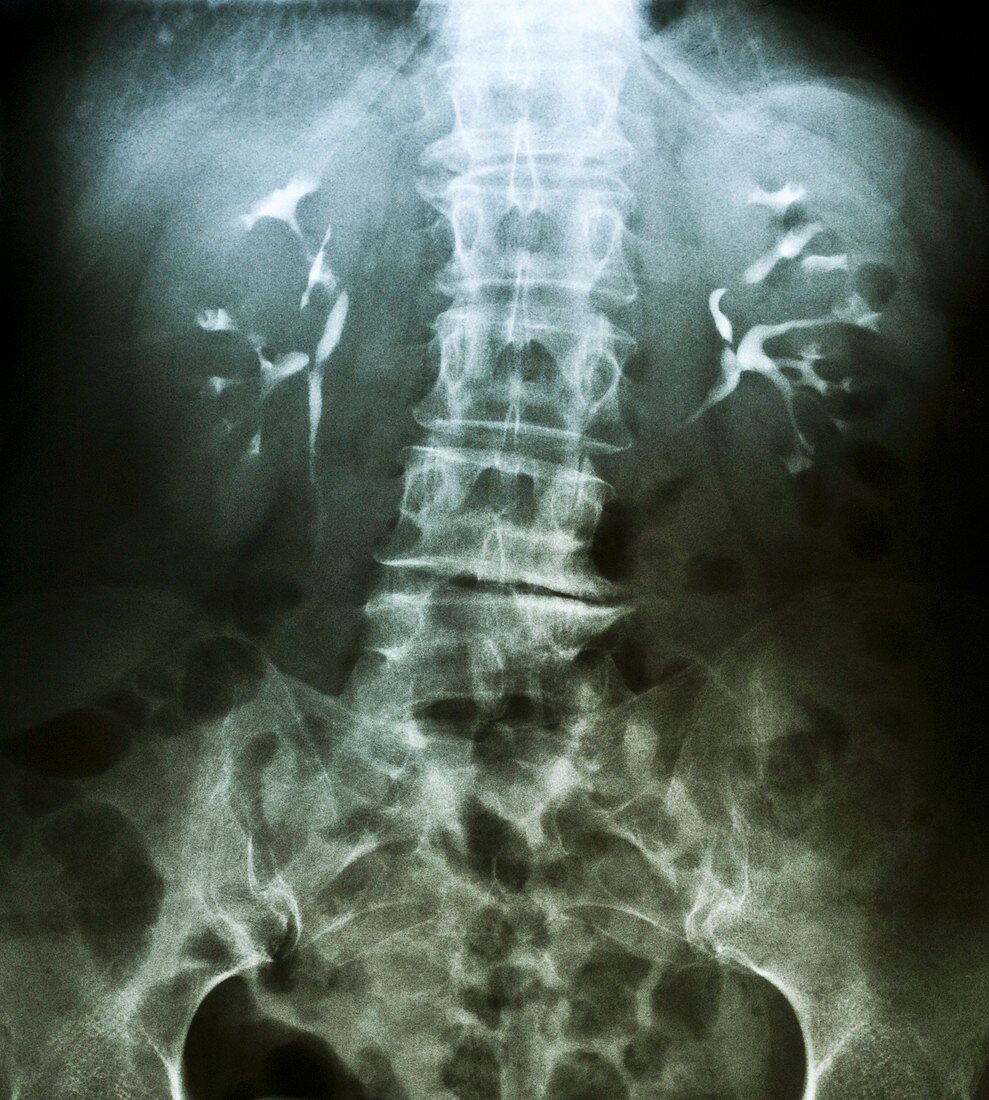 False-col X-ray of lumbar spine of woman