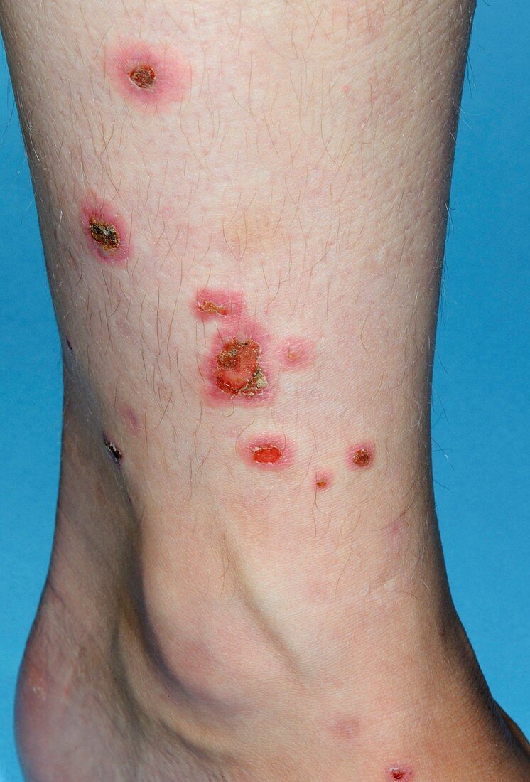 Erythema multiforme rash on leg