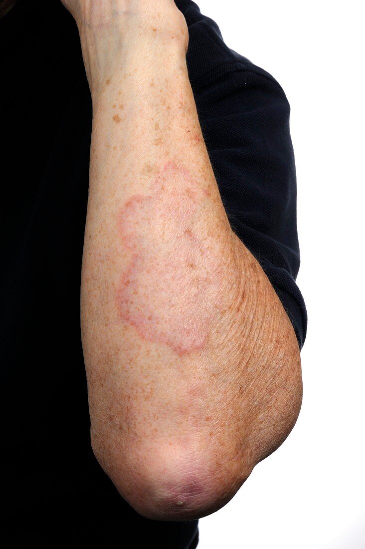 Granuloma annulare on the arm