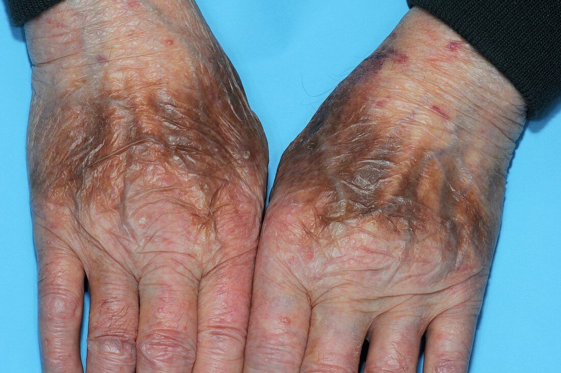 Hand pigmentation from drug side effect