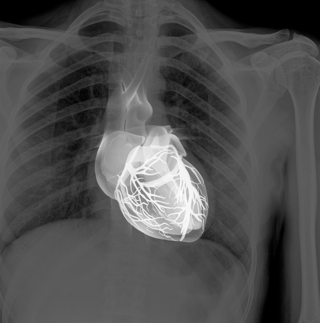 Heart and lungs,chest X-ray composite