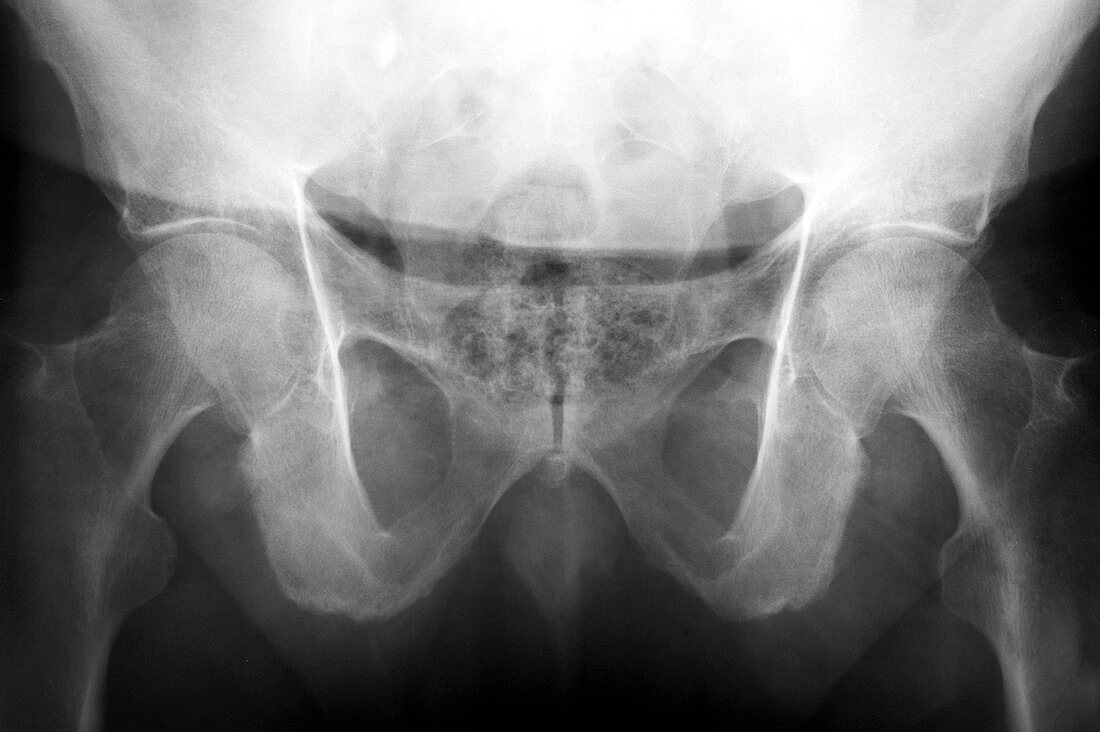 Sacroilitis,X-ray
