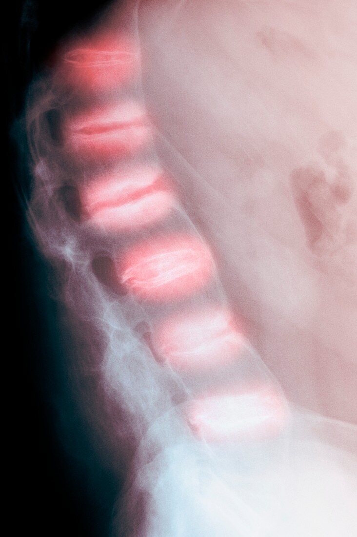 Ankylosing spondylitis,X-ray