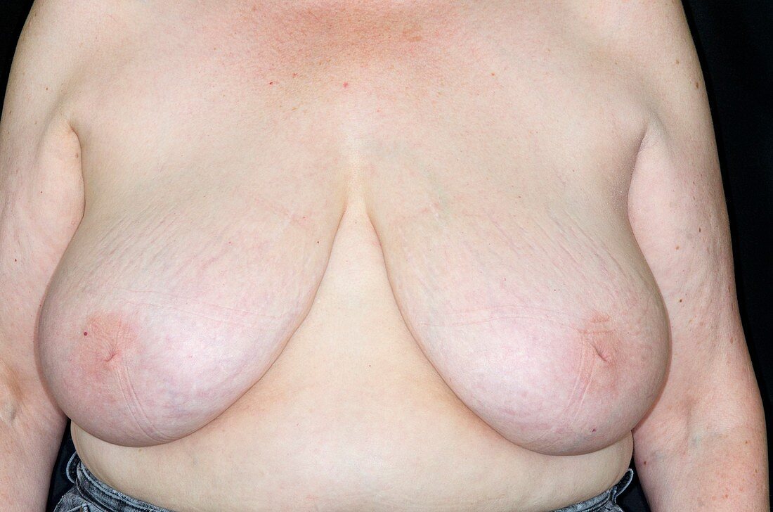 Woman with inverted nipples