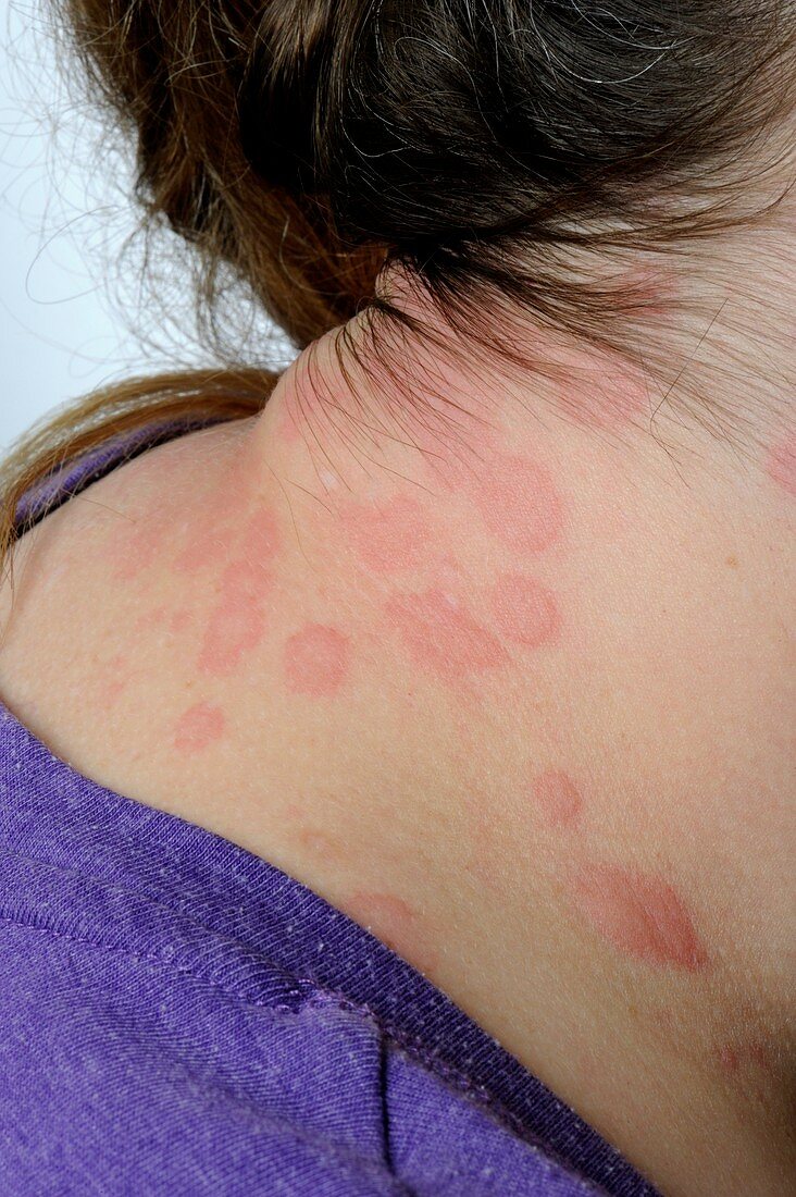 Urticaria on the neck