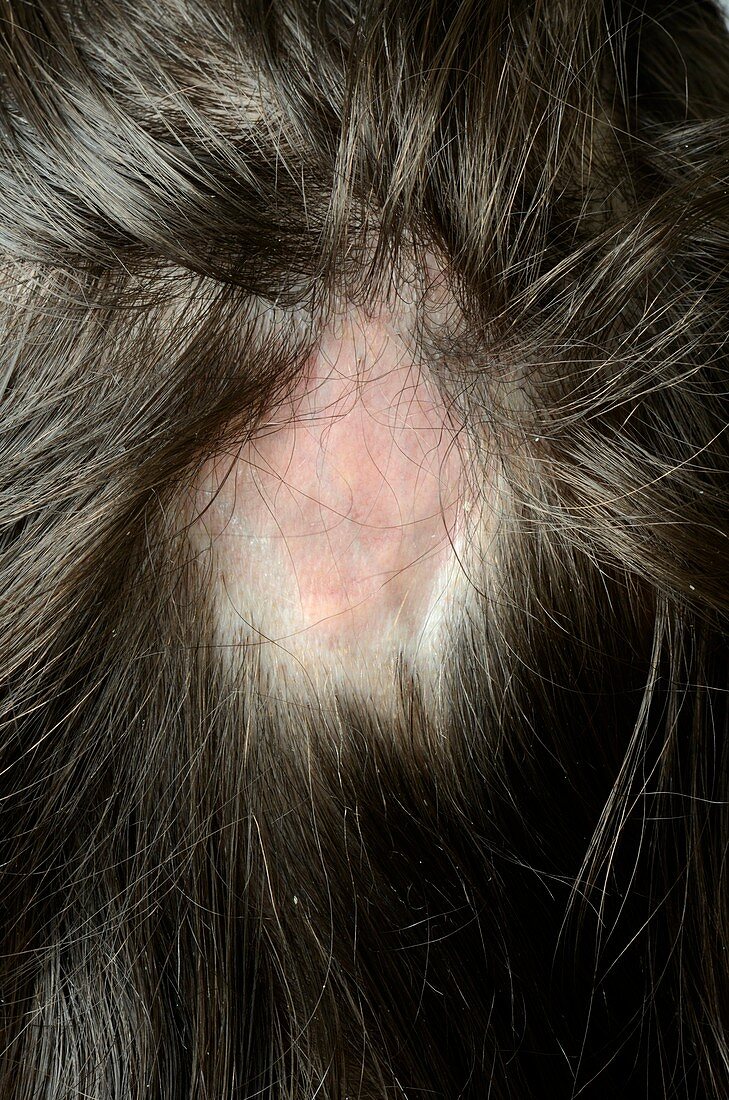 Scarring alopecia (hair loss)