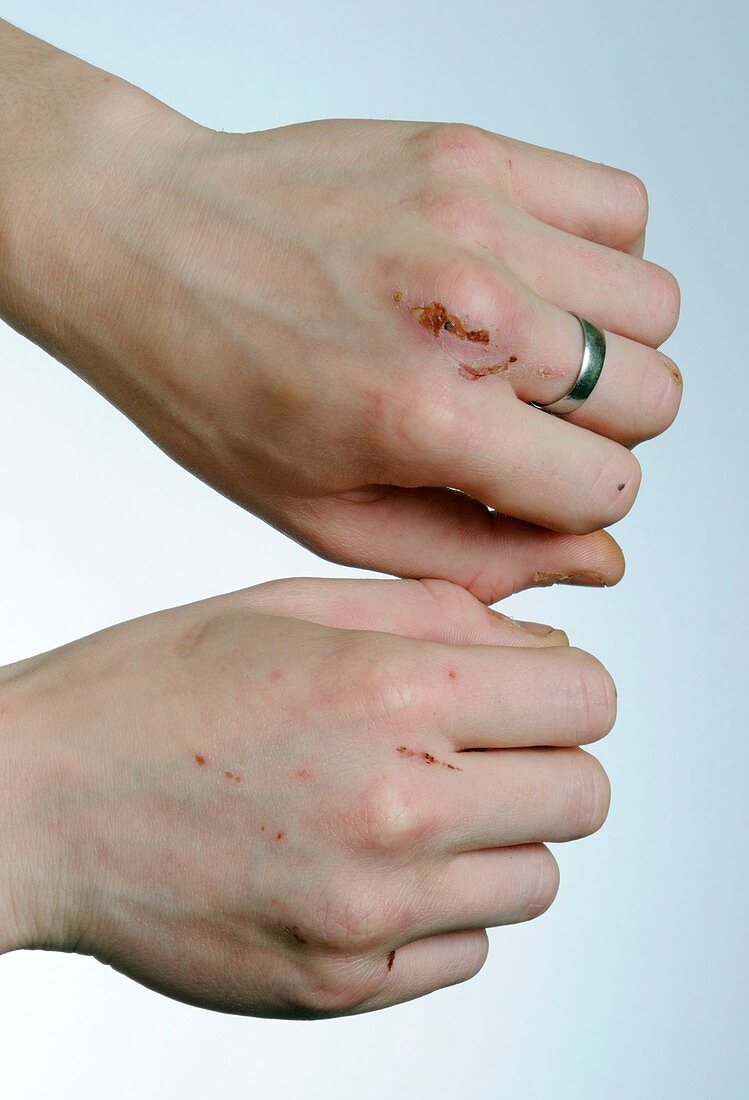 Scars from self harm on the hands