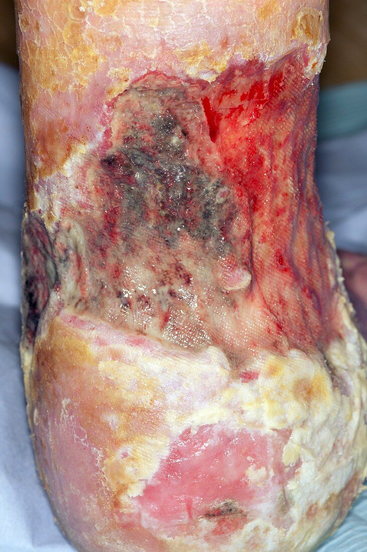 Chronic venous ulcers on the ankle