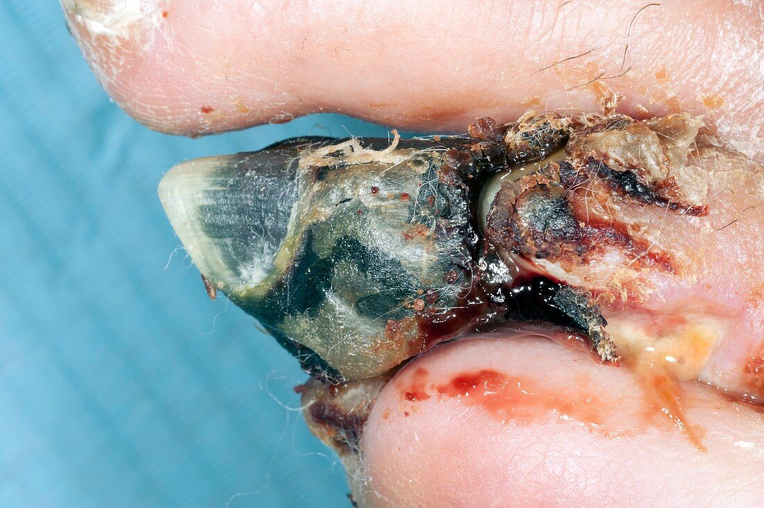 Gangrenous toe in a diabetic