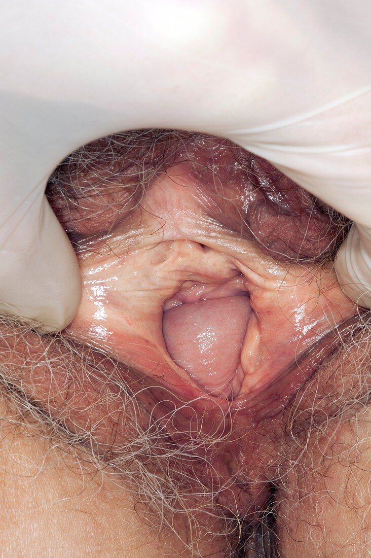 Prolapse of the vaginal wall