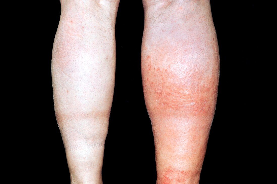 Deep vein thrombosis in the leg