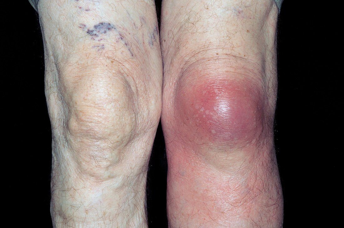 Bursitis of the knee