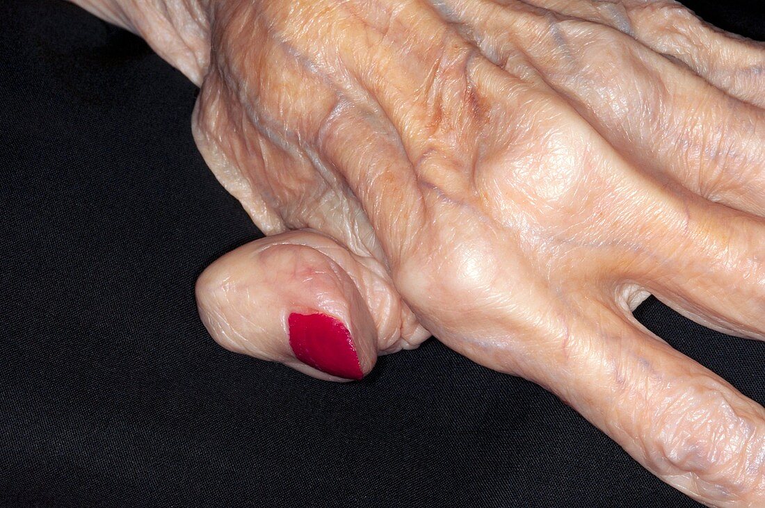Rheumatoid arthritis of the finger