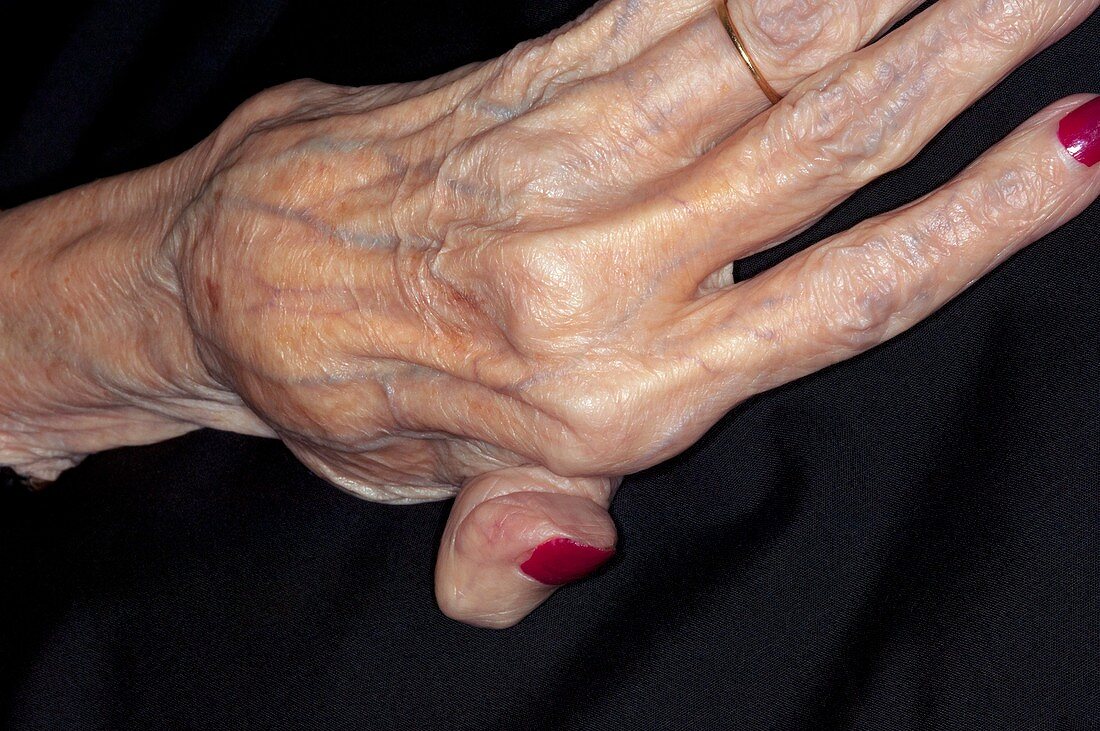 Rheumatoid arthritis of the finger