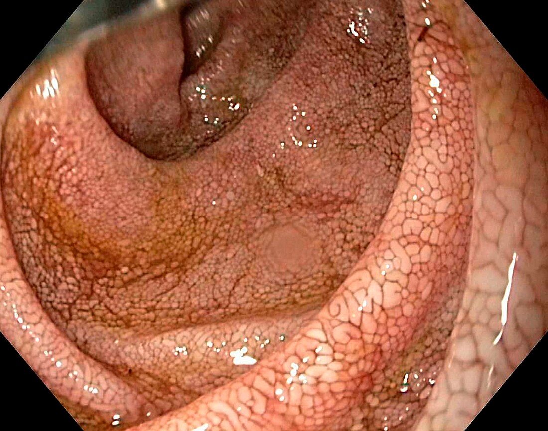 Duodenum in Whipples disease