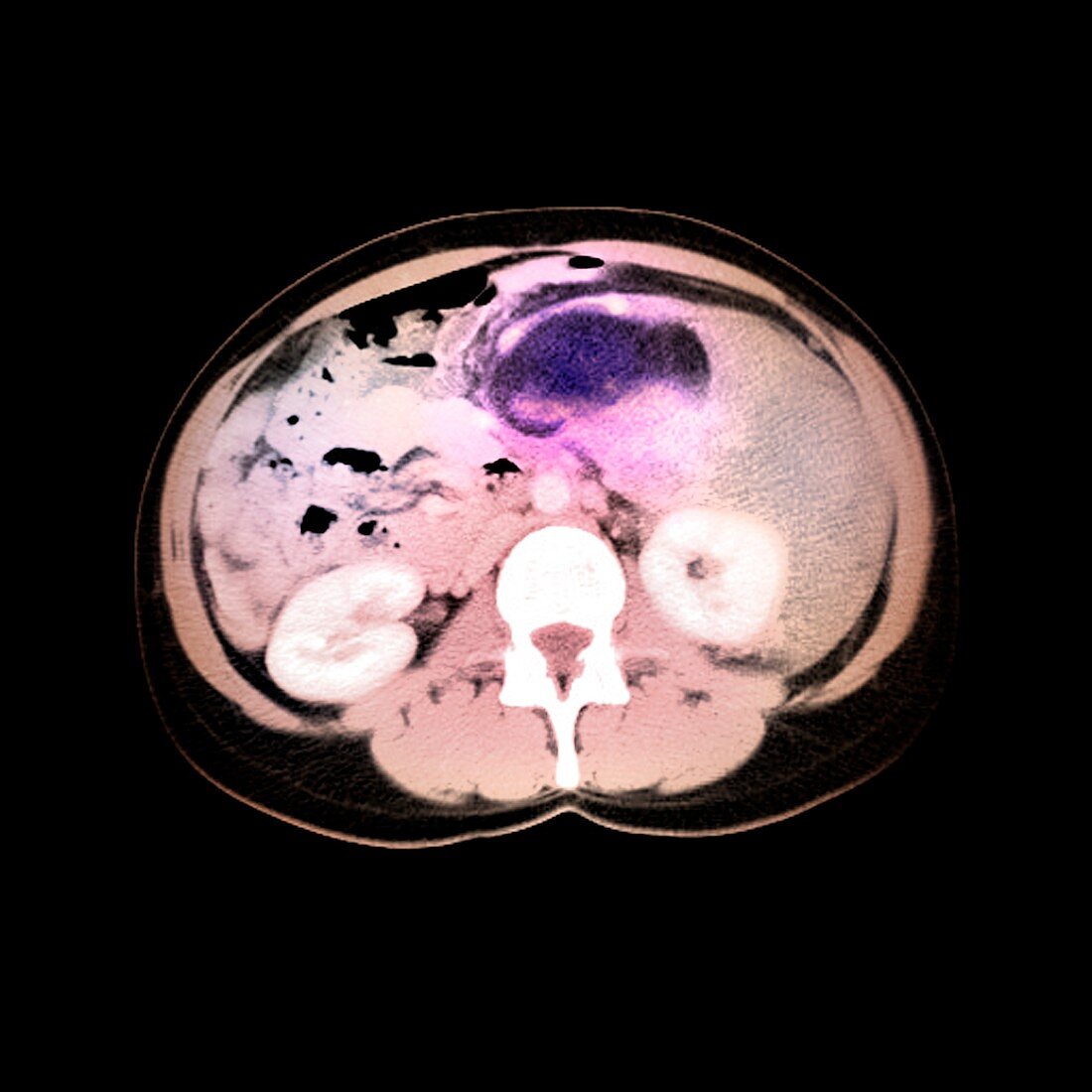 Liposarcoma,MRI scan