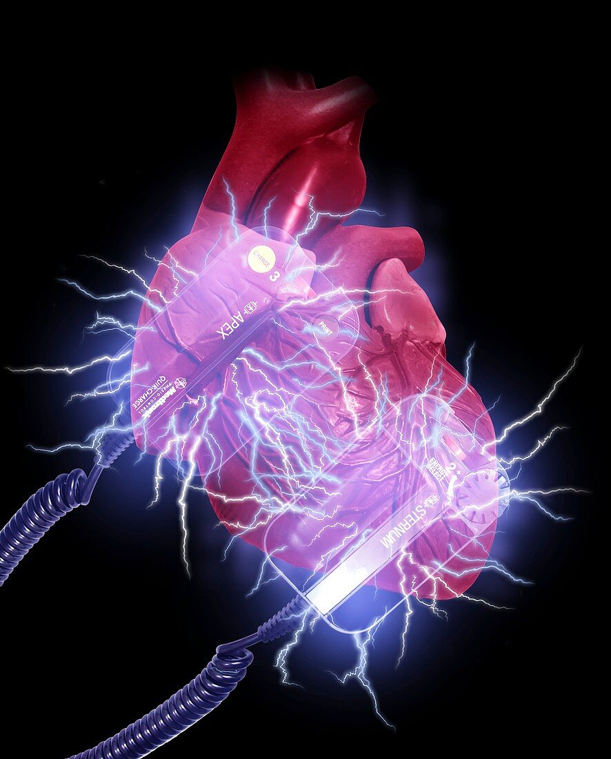 Defibrillator paddles shock the heart