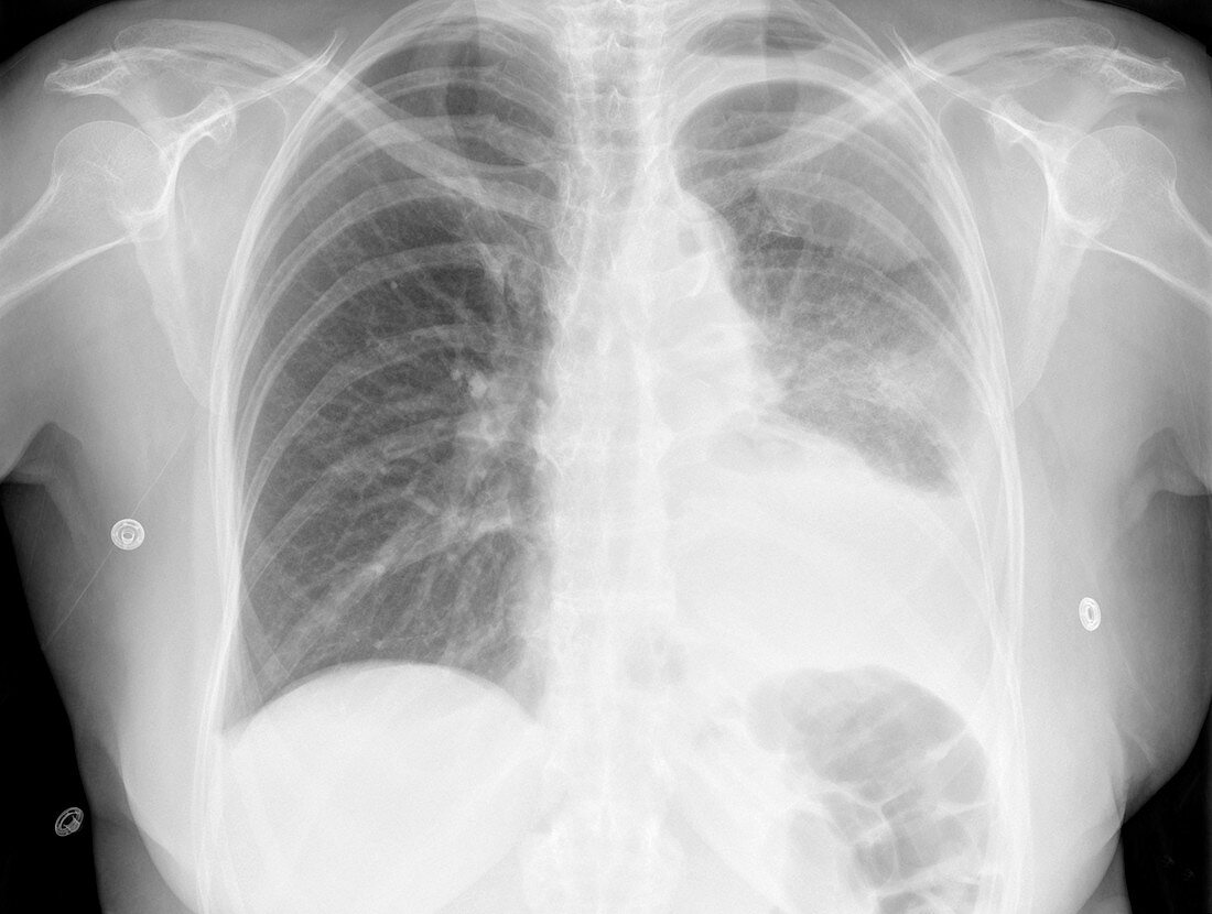 Pleural effusion,X-ray