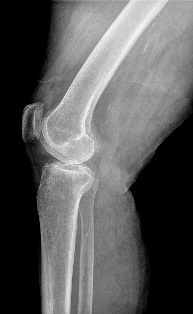 Calcified knee joint,X-ray