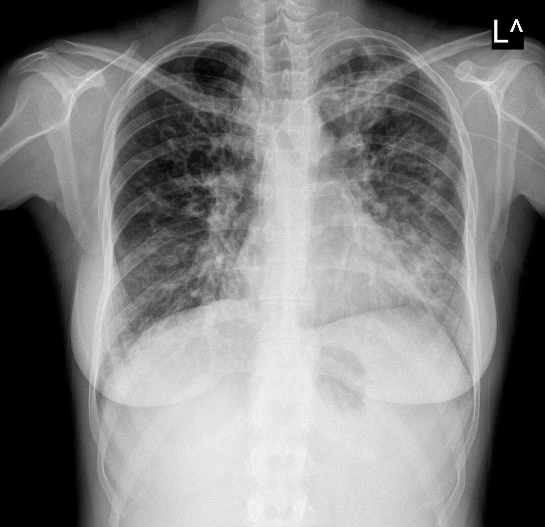 Cystic fibrosis,X-ray