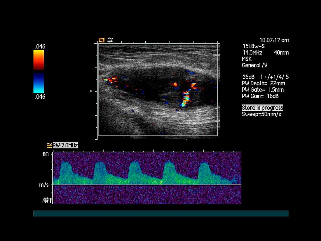 Buttock cancer,Doppler ultrasound scan